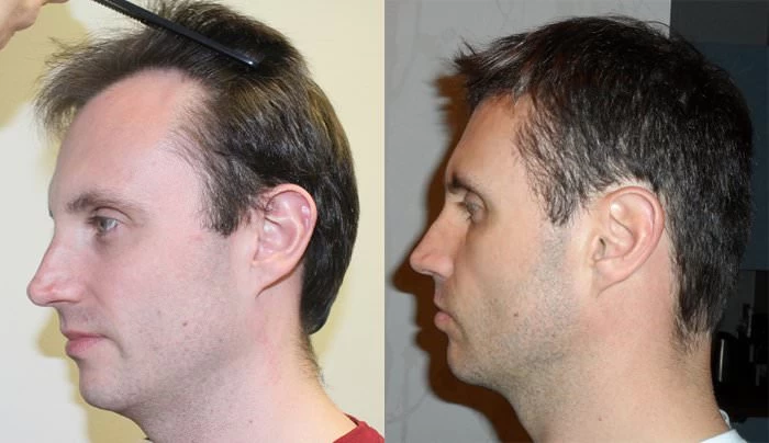 Patient p156 hair transplant before and after left view