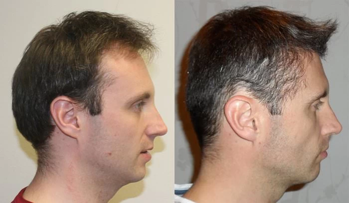 Patient p156 hair transplant before and after right view