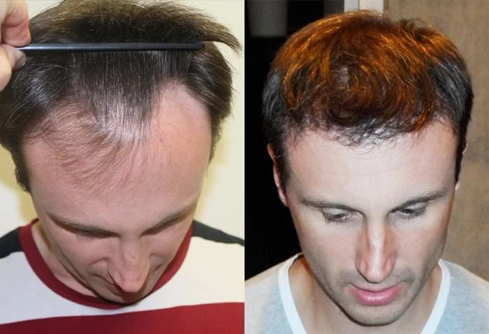Patient p156 hair transplant before and after tilt view