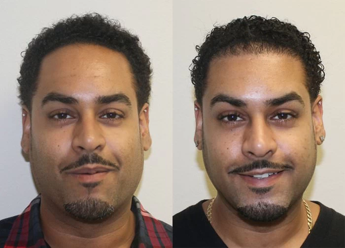Shawn  Hair Transplant Before and After