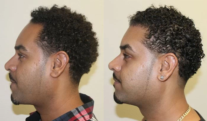 Patient p158 hair transplant before and after left view
