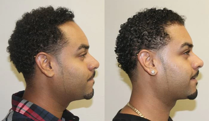 Patient p158 hair transplant before and after right view