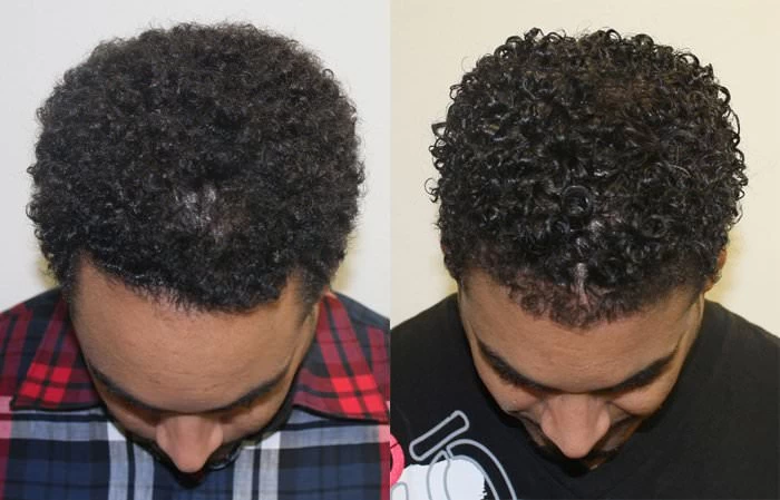 Patient p158 hair transplant before and after tilt view