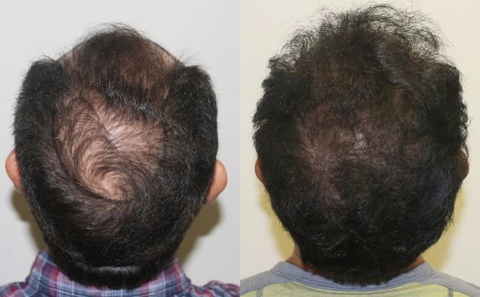 Patient p168 hair transplant before and after crown view