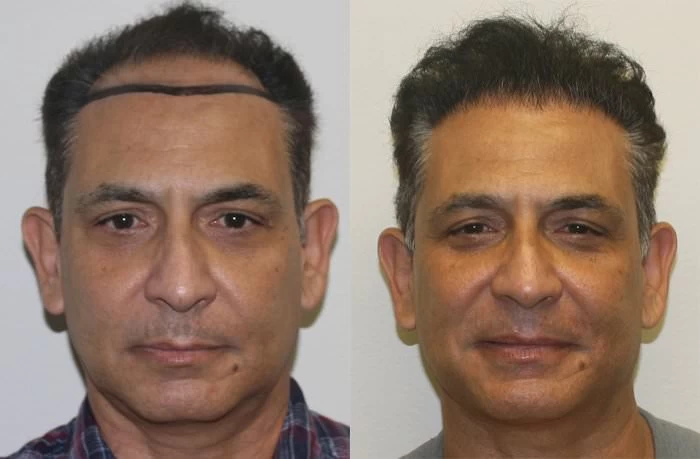 Alberto Hair Transplant Before and After