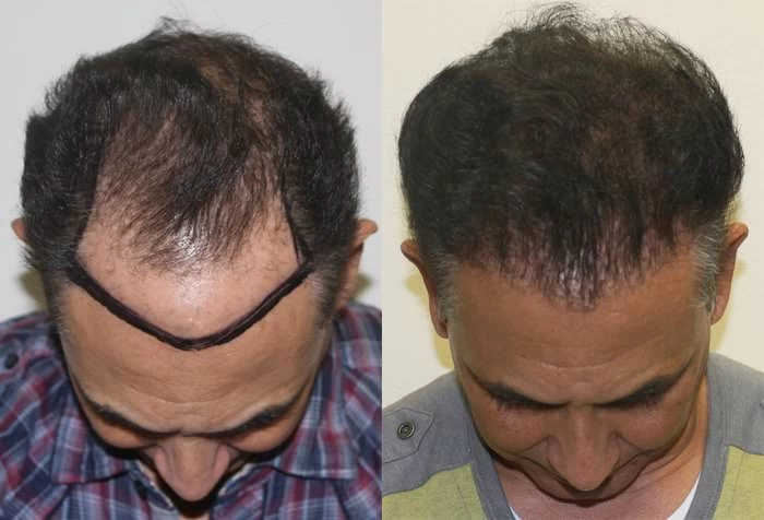 Patient p168 hair transplant before and after tilt view