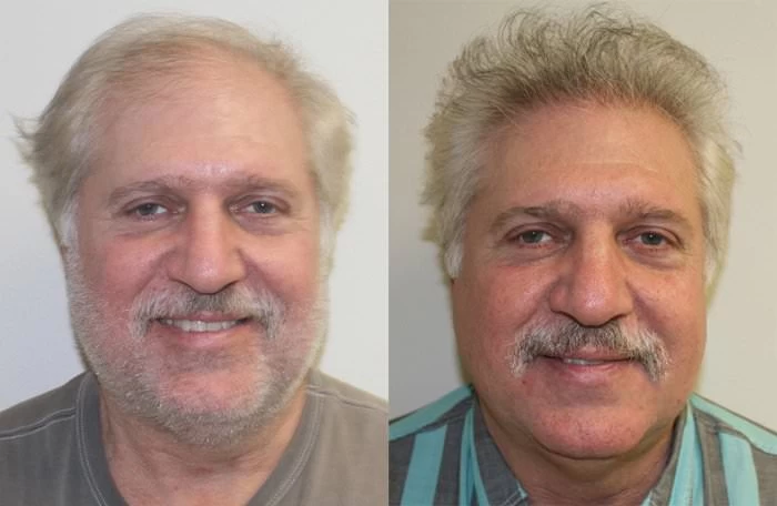 Rick Hair Transplant Before and After