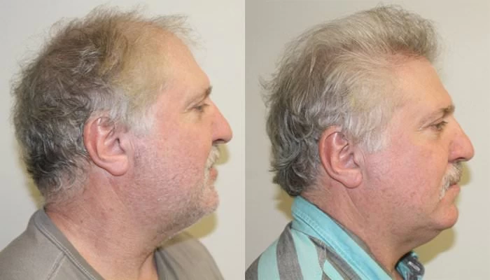 Patient p170 hair transplant before and after right view