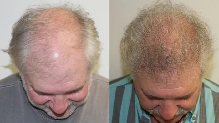Patient p170 hair transplant before and after tilt view