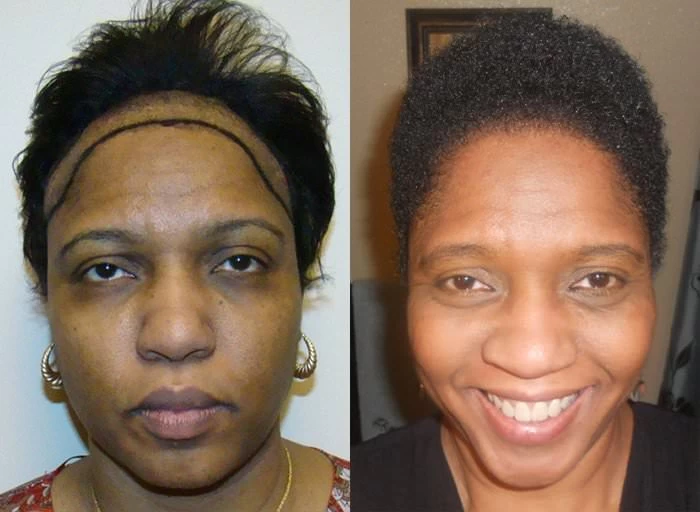 Patient 174 Hair Transplant Before and After