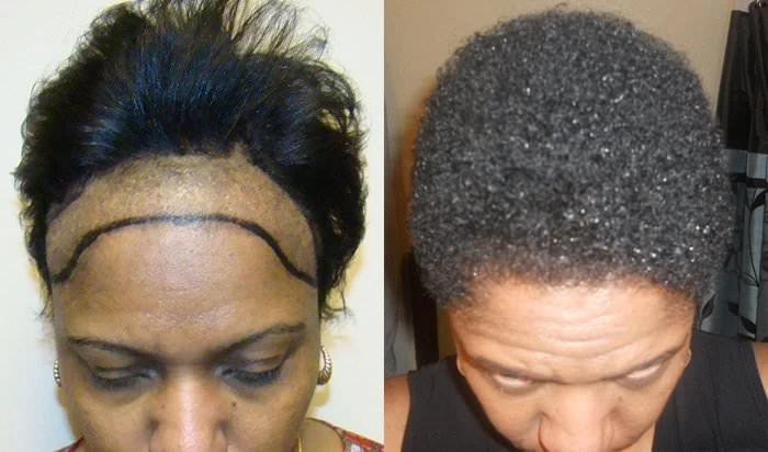 Patient p174 hair transplant before and after tilt view