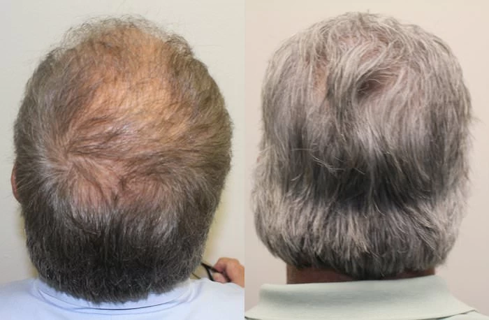 Patient p175 hair transplant before and after crown view