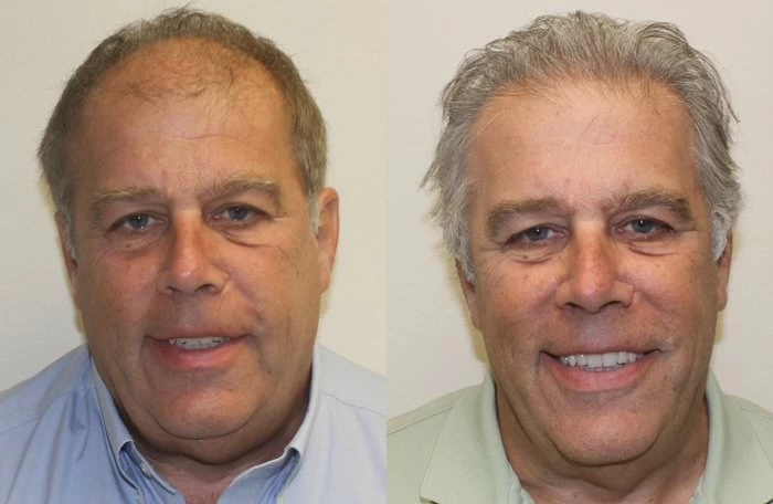 Joseph Hair Transplant Before and After