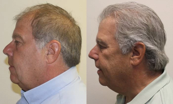 Patient p175 hair transplant before and after left view