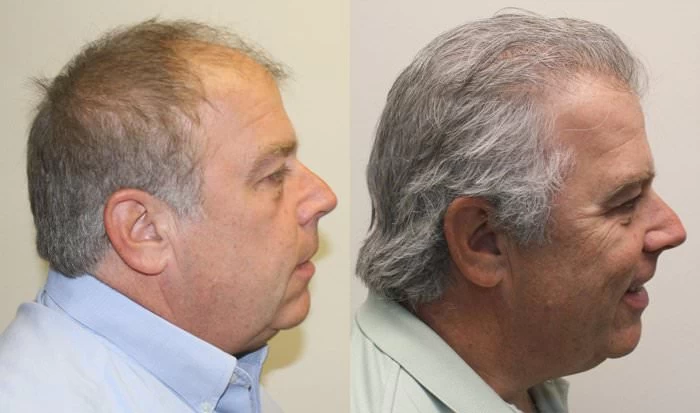 Patient p175 hair transplant before and after right view