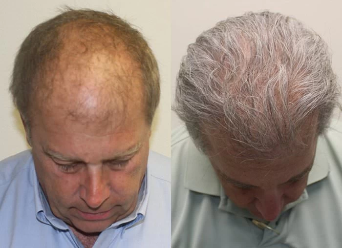 Patient p175 hair transplant before and after tilt view