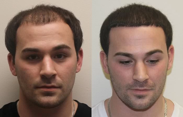 Rich Hair Transplant Before and After