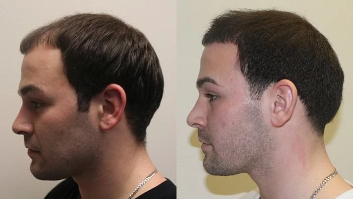 Patient p177 hair transplant before and after left view