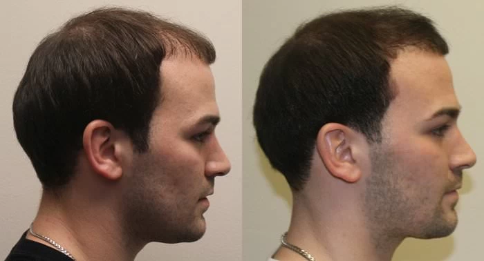 Patient p177 hair transplant before and after right view