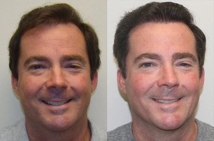 Doug Hair Transplant Before and After