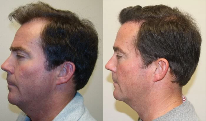 Patient p179 hair transplant before and after left view