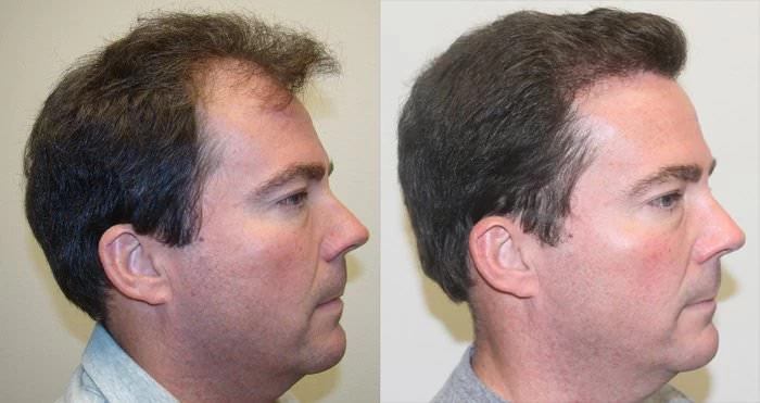 Patient p179 hair transplant before and after right view