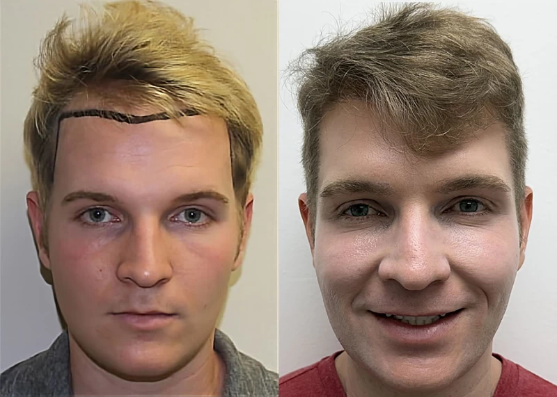 Jack Hair Transplant Before and After