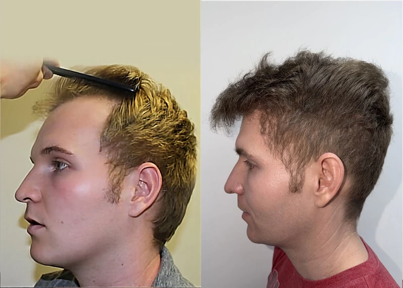 Patient p180 hair transplant before and after left view