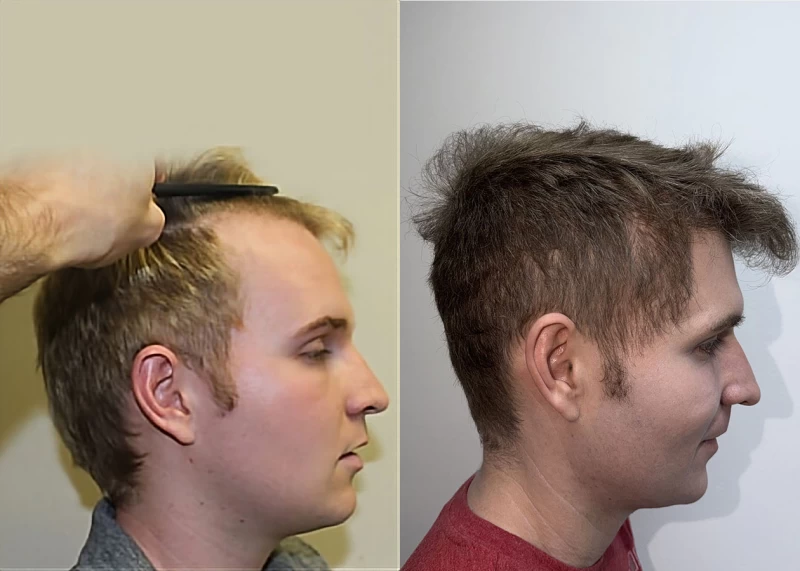 Patient p180 hair transplant before and after right view