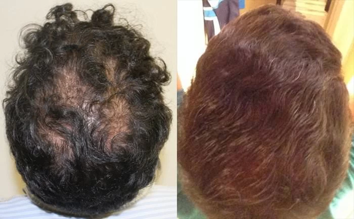 Patient p181 hair transplant before and after crown view