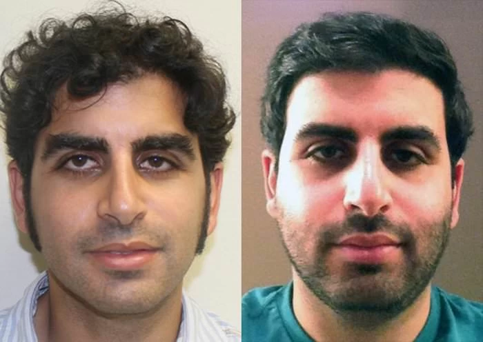David Hair Transplant Before and After