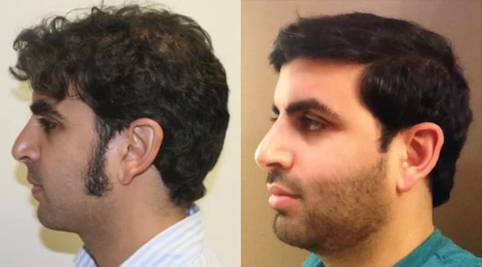 Patient p181 hair transplant before and after left view