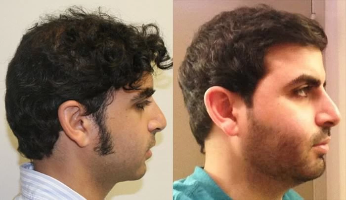 Patient p181 hair transplant before and after right view