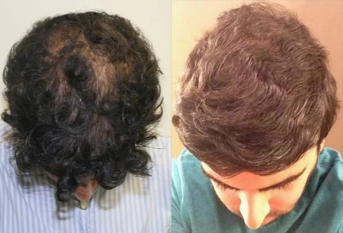 Patient p181 hair transplant before and after tilt view