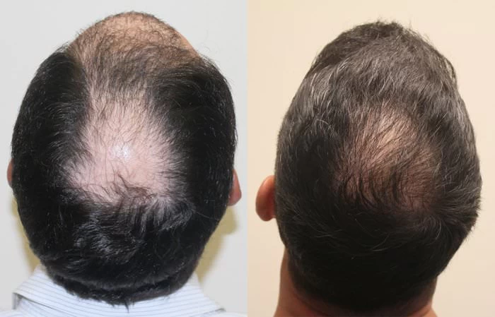 Patient p183 hair transplant before and after crown view