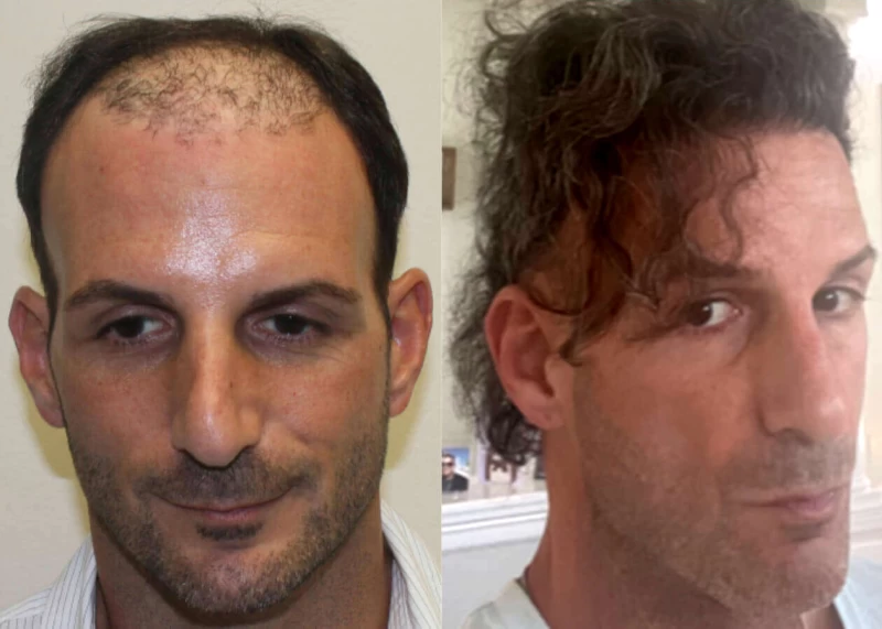Patient p183 hair transplant before and after front view