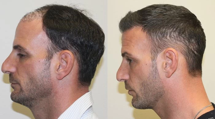Patient p183 hair transplant before and after left view