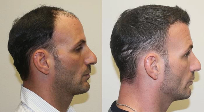 Patient p183 hair transplant before and after right view