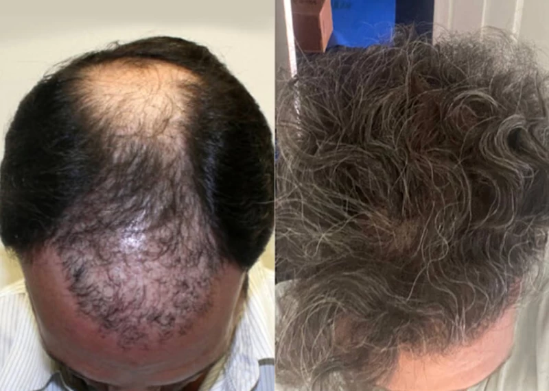 Patient p183 hair transplant before and after tilt view