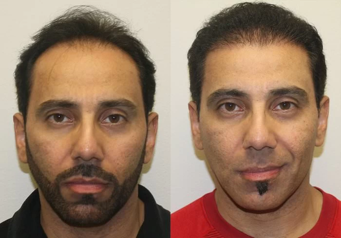 Juan Hair Transplant Before and After