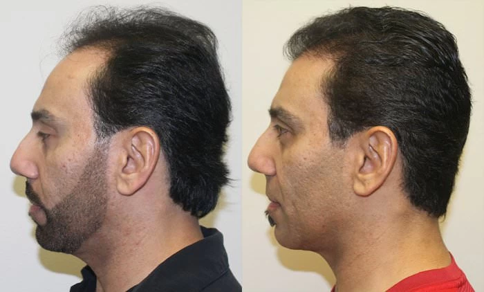 Patient p185 hair transplant before and after left view