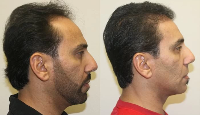 Patient p185 hair transplant before and after right view