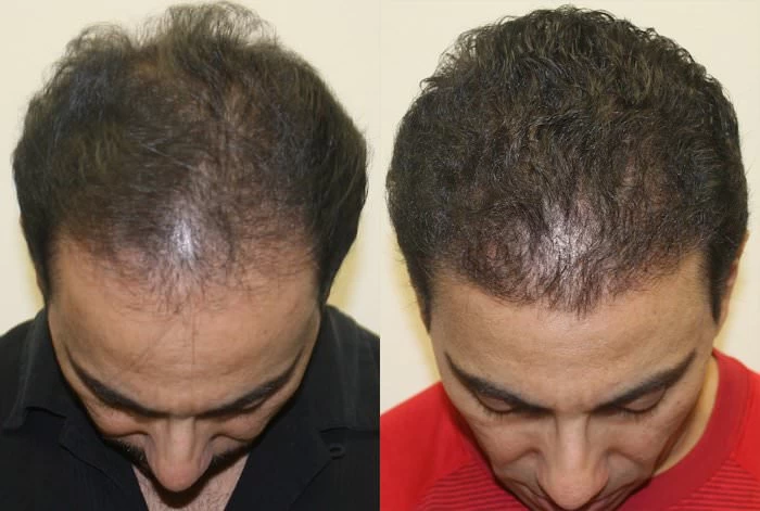 Patient p185 hair transplant before and after tilt view