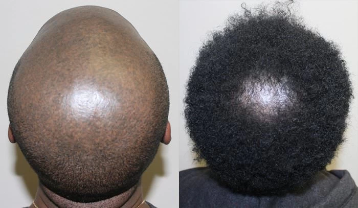 Patient p188 hair transplant before and after crown view