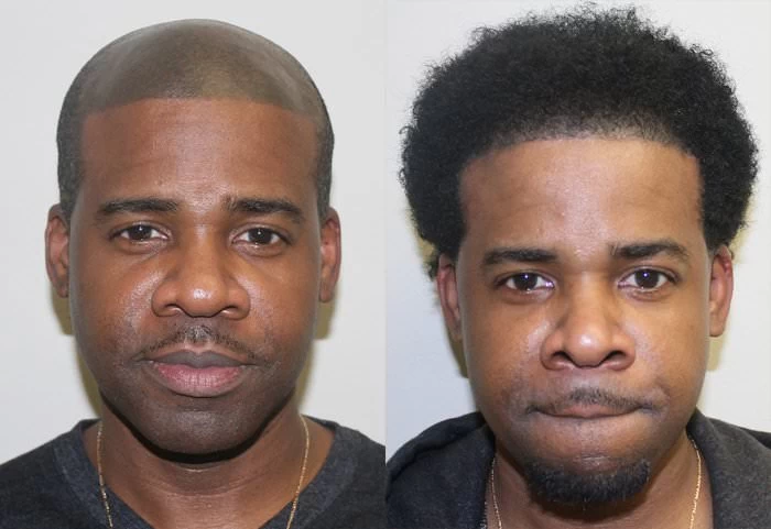Patient James African American hair transplant before and after results