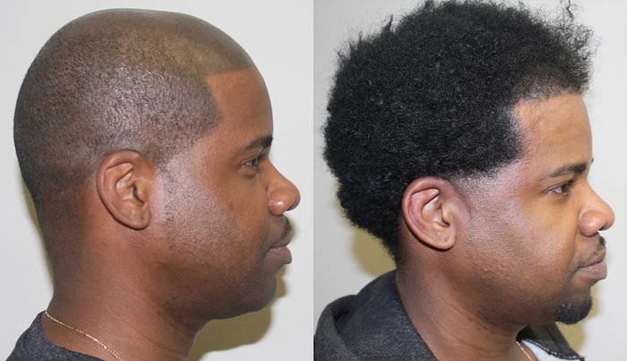 Patient p188 hair transplant before and after right view