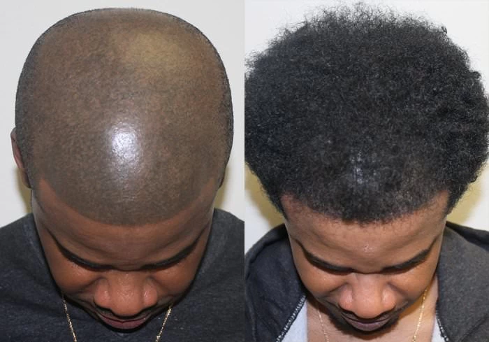Patient p188 hair transplant before and after tilt view