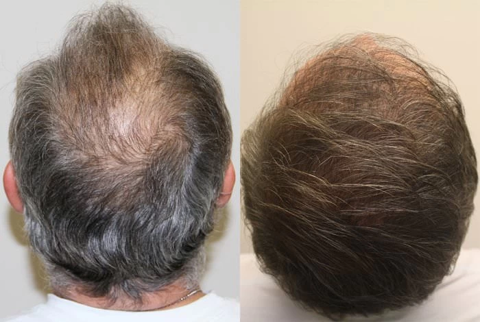 Patient p192 hair transplant before and after crown view