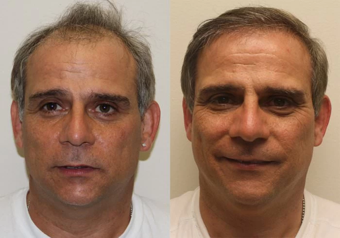 Patient 192 Hair Transplant Before and After