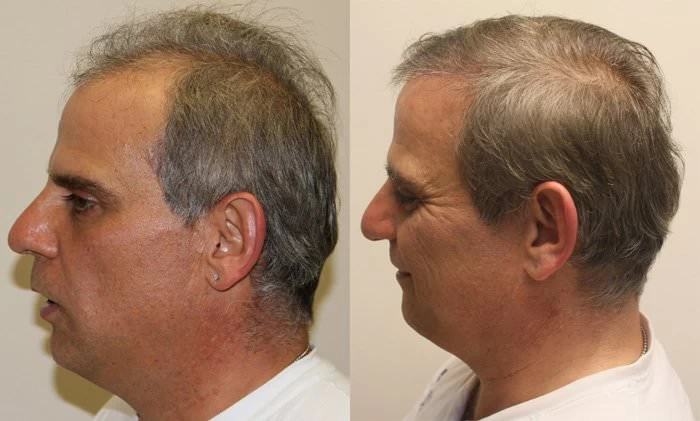Patient p192 hair transplant before and after left view